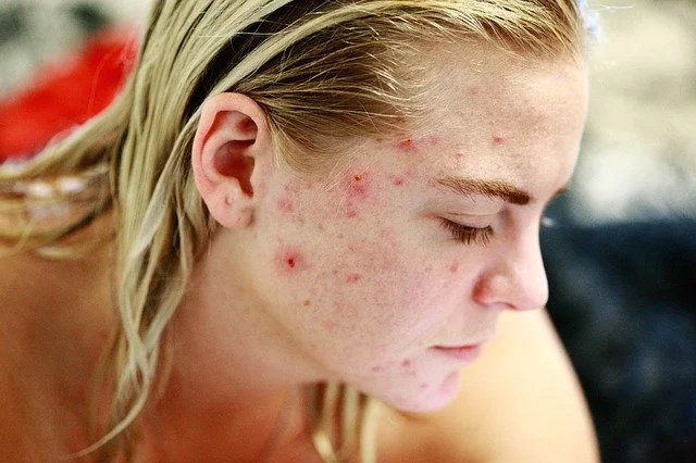 A folha da uva ajuda a diminuir até manchas de acne