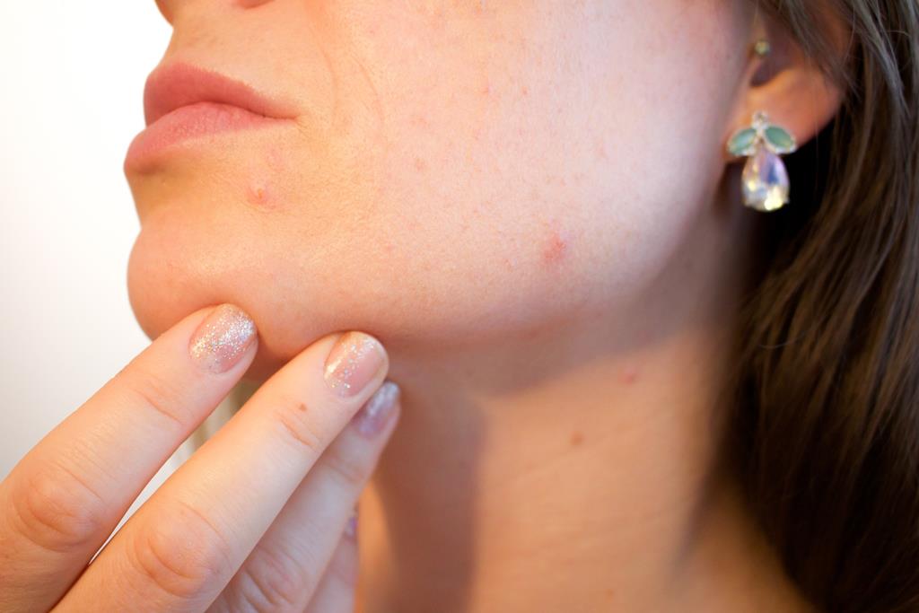 a biotina pode ser usada também no tratamento de acnes