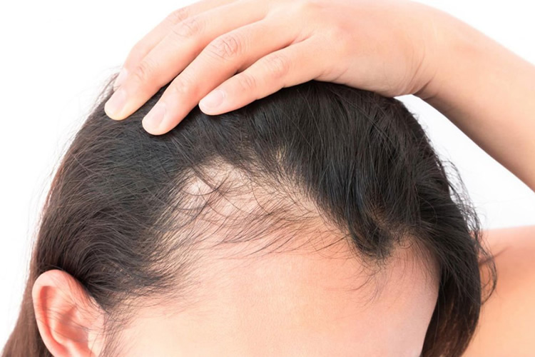 O que é bom para alopecia androgenética feminina?