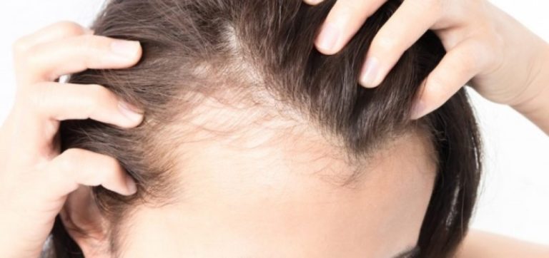 9 doenças que podem causar queda de cabelo