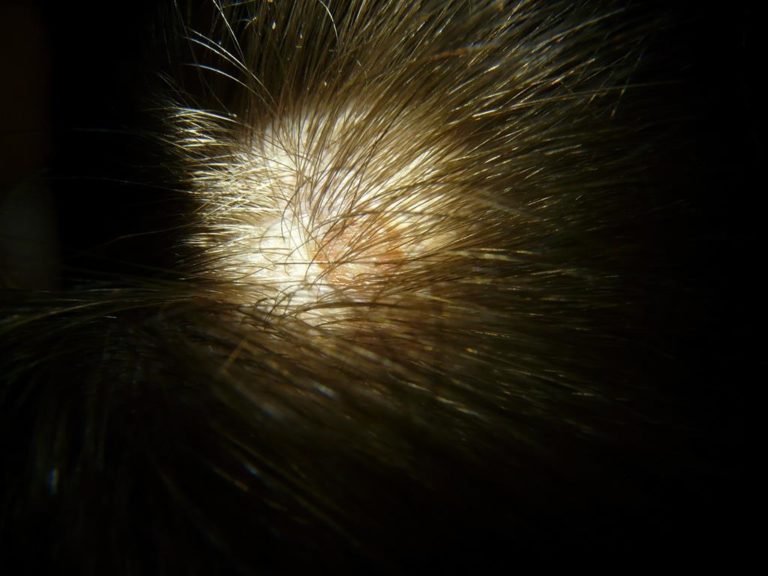 Sintomas e tratamento da Micose no couro cabeludo