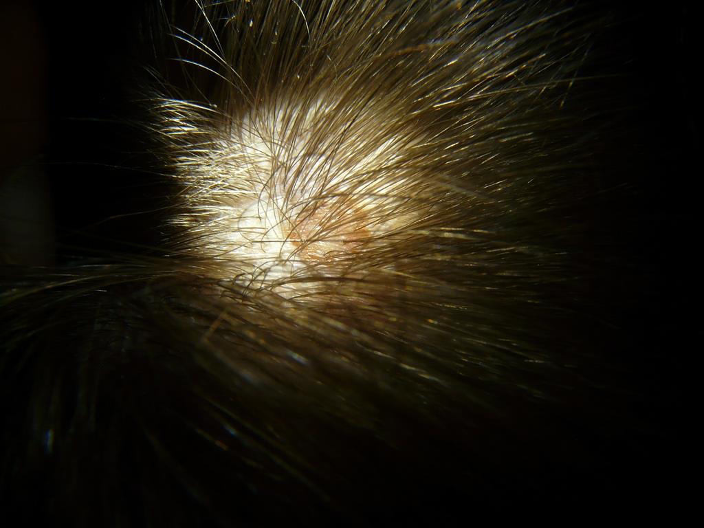 micose no couro cabeludo
